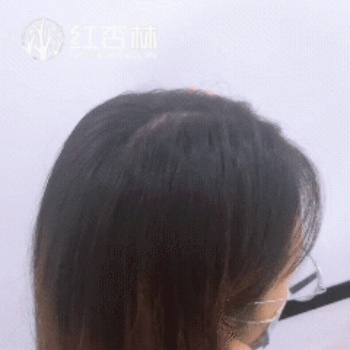 百會穴所在位置